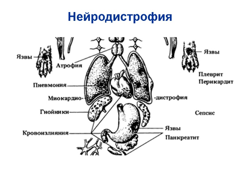 Нейродистрофия